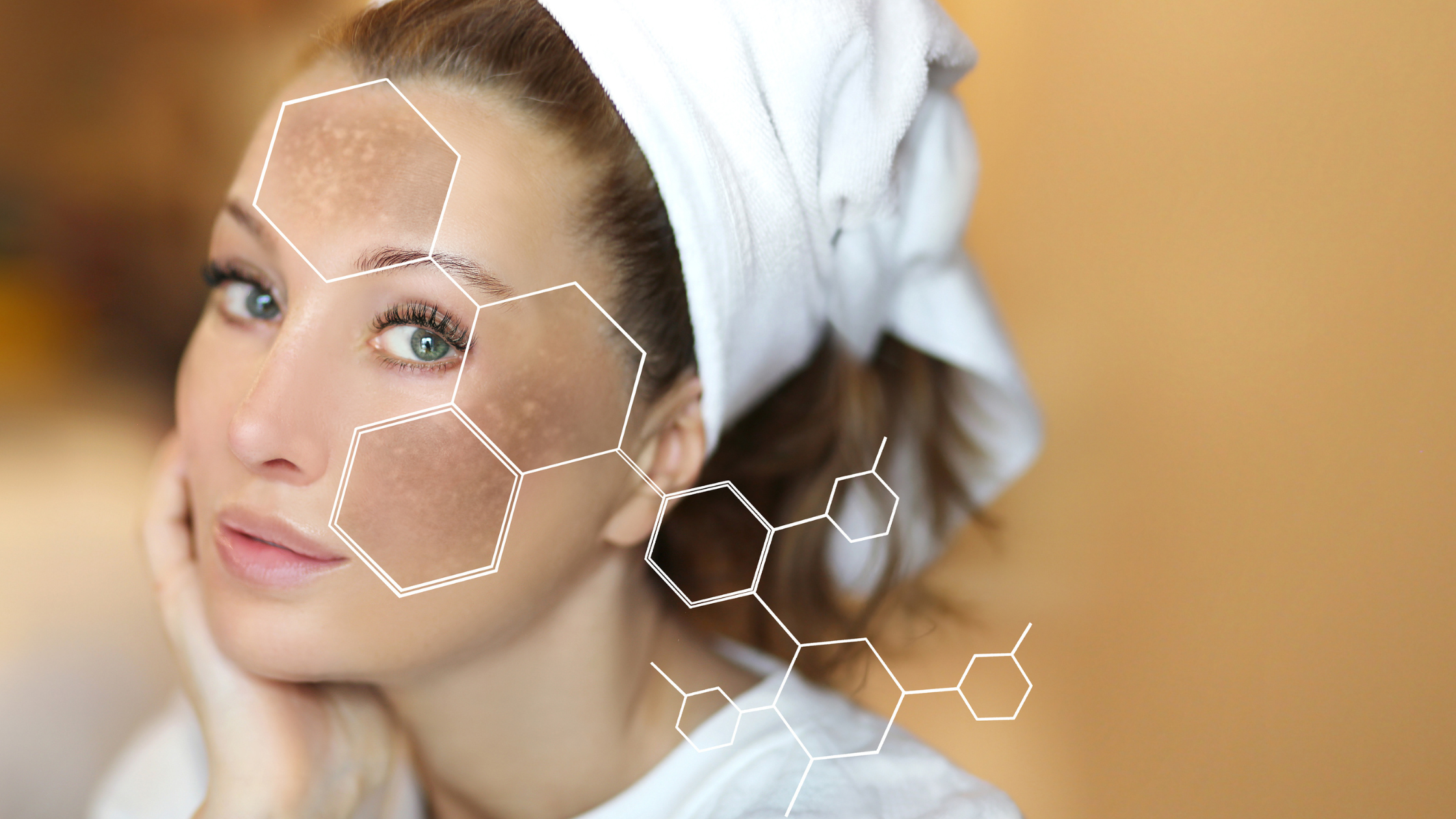 Is Hyperpigmentation the Same as Melasma?